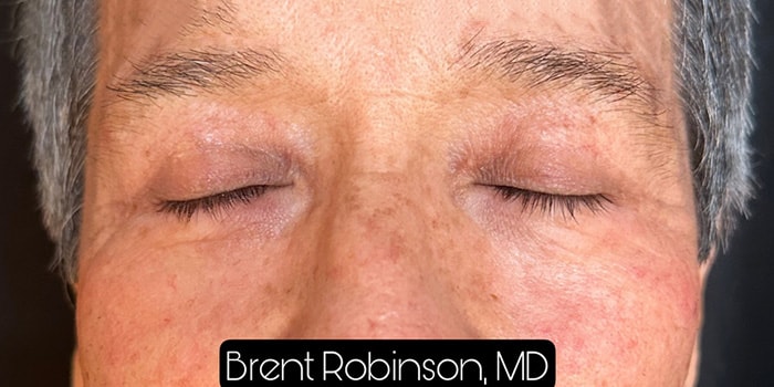 Blepharoplasty Gallery Before & After Image