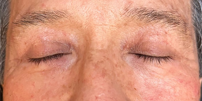 Blepharoplasty Gallery Before & After Image