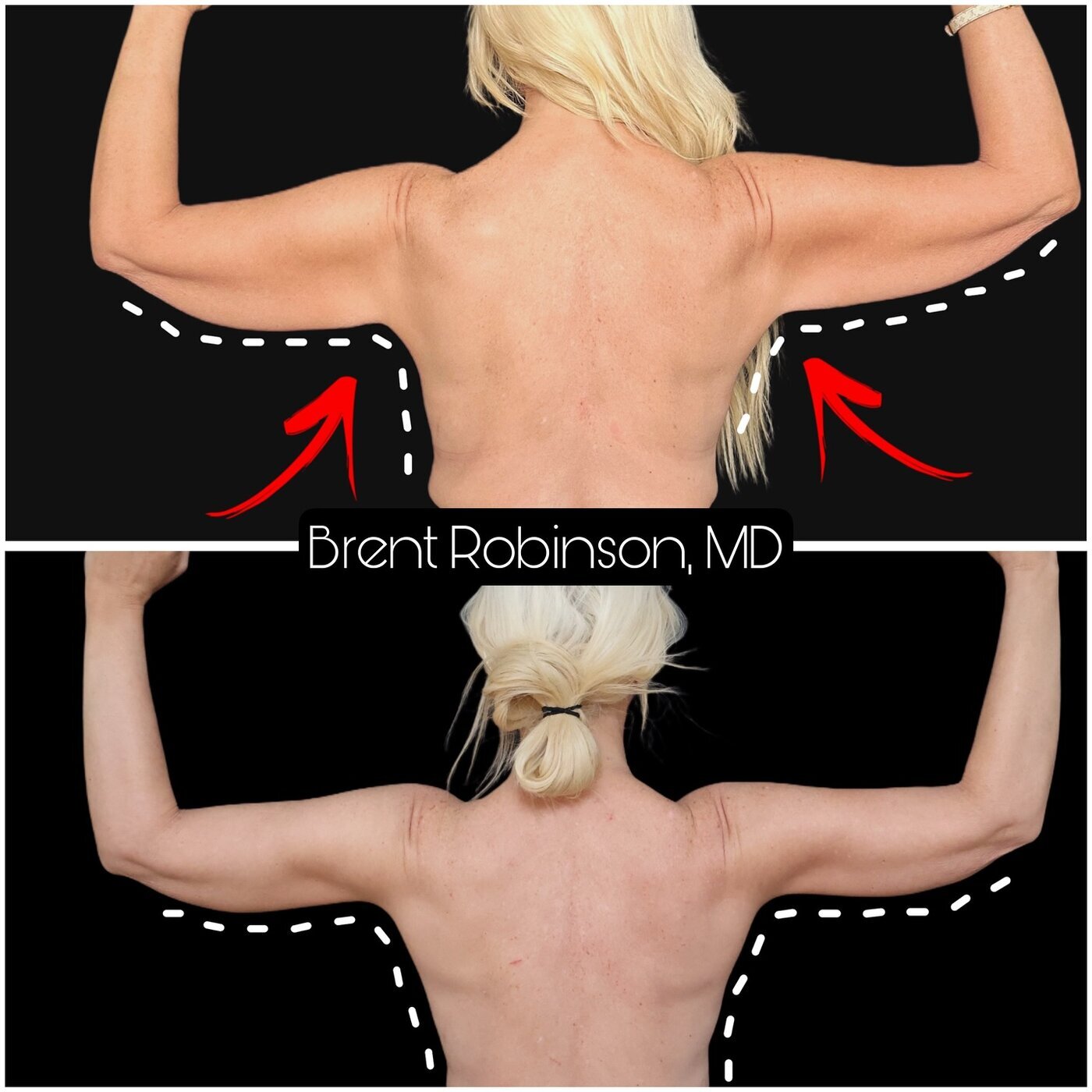 Arm Lift Gallery Before & After Image