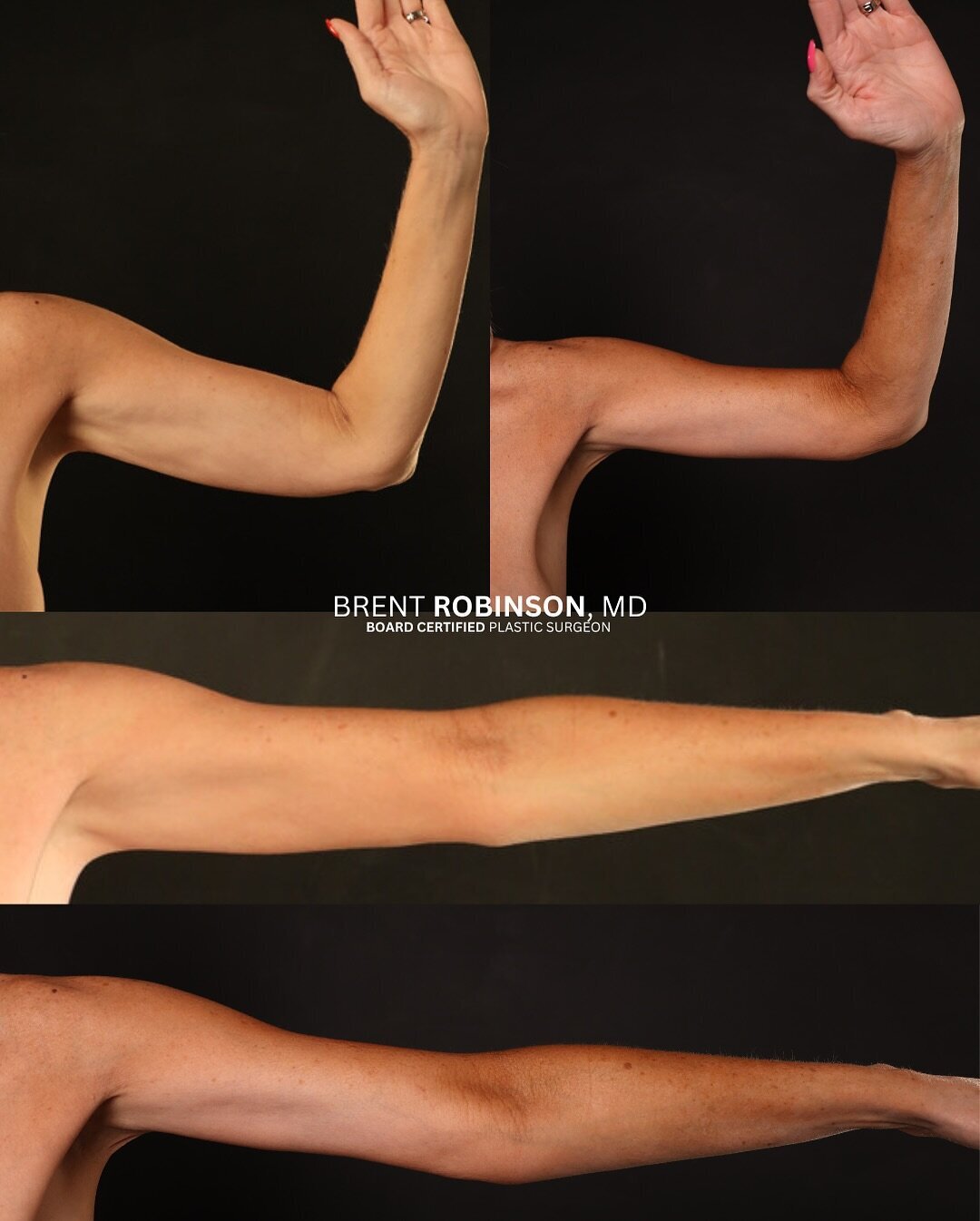 Arm Lift Gallery Before & After Image