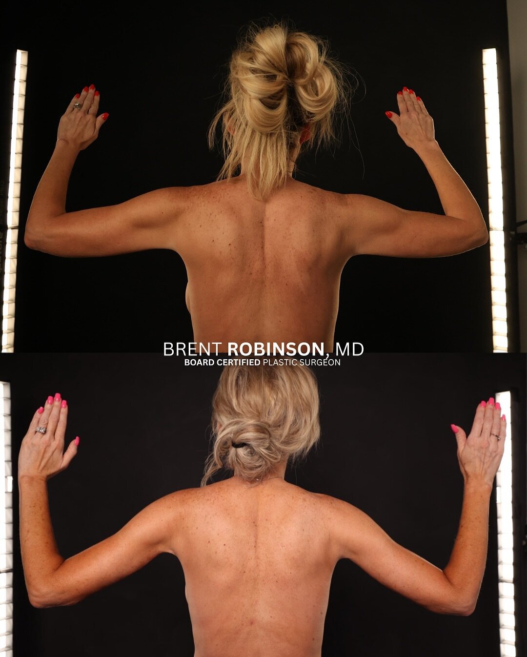 Arm Lift Gallery Before & After Image