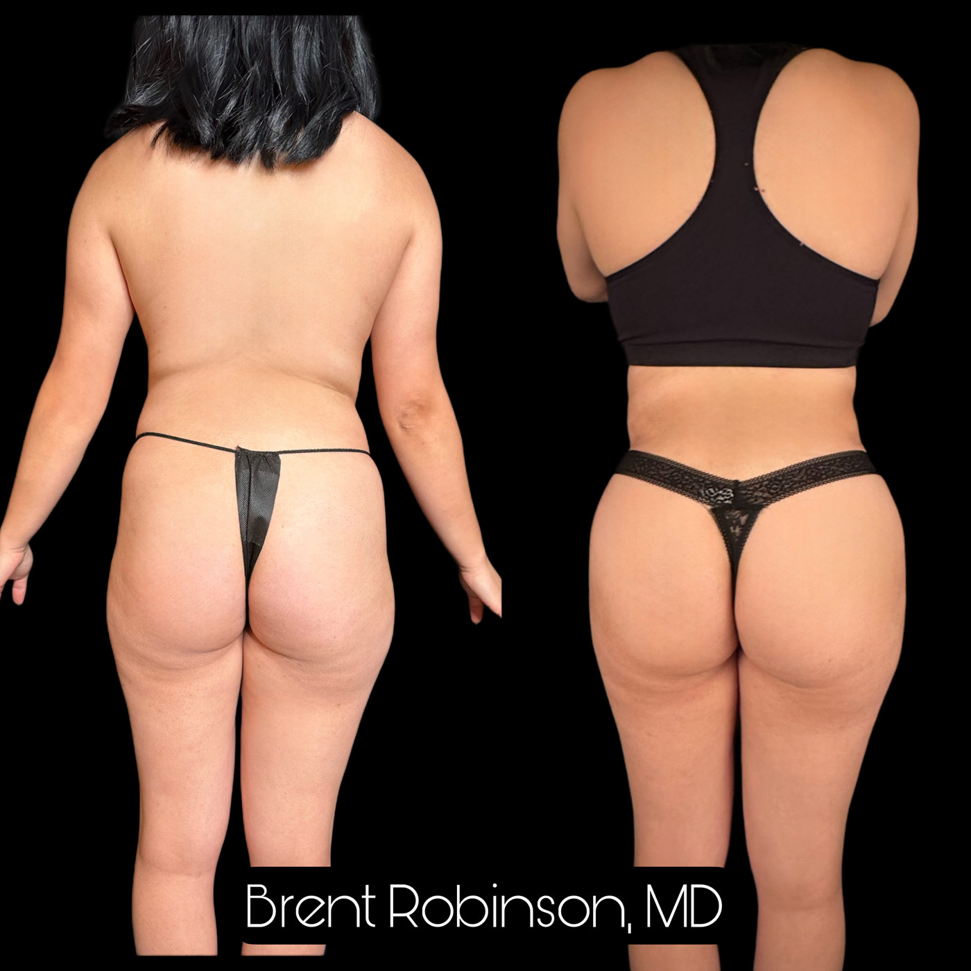 Brazilian Butt Lift Gallery Before & After Image