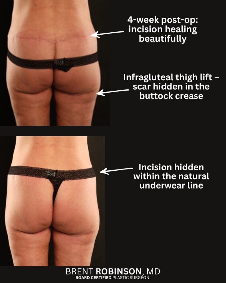 Lower Body Lift Gallery Before & After Image