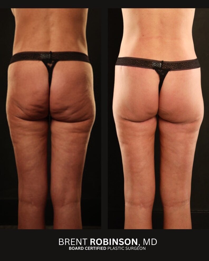 Lower Body Lift Gallery Before & After Image