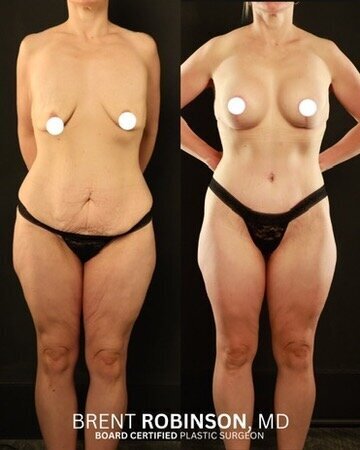 Mommy Makeover Gallery Before & After Image