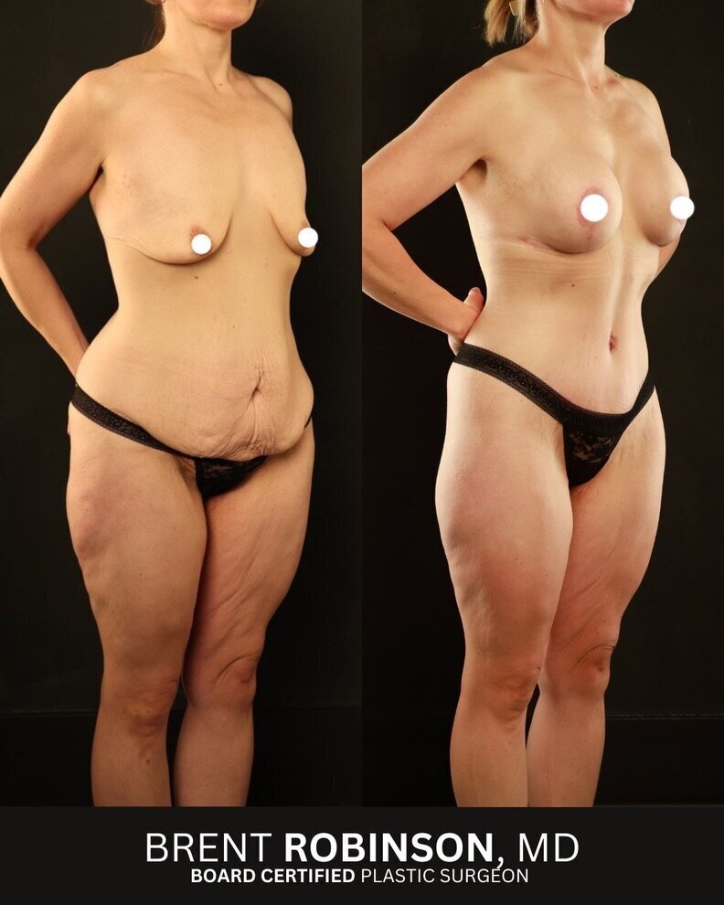 Mommy Makeover Gallery Before & After Image
