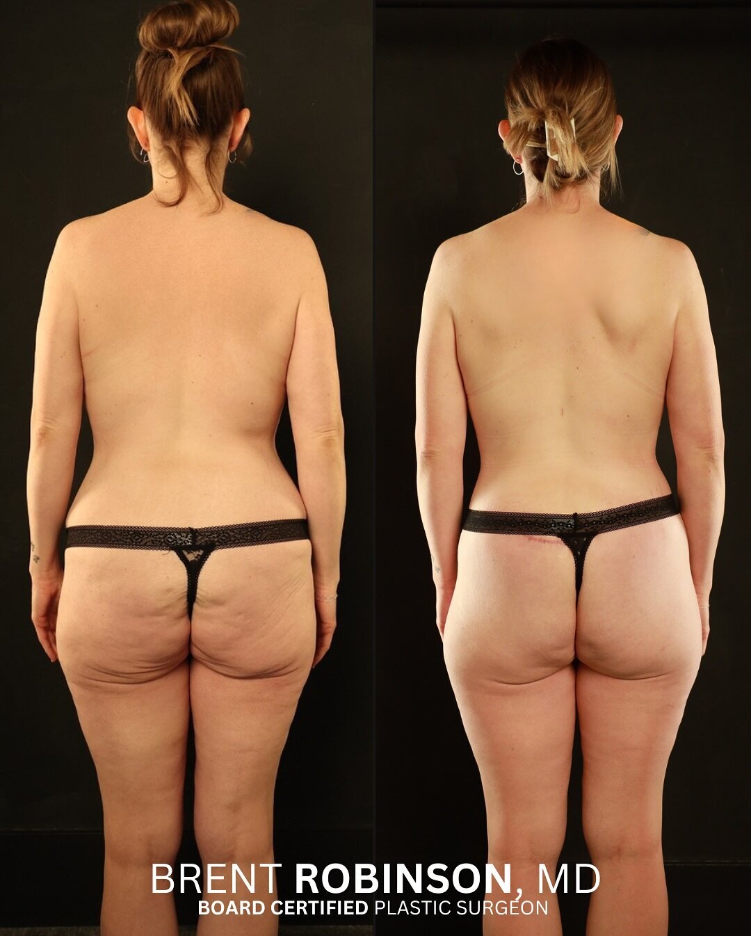 Mommy Makeover Gallery Before & After Image