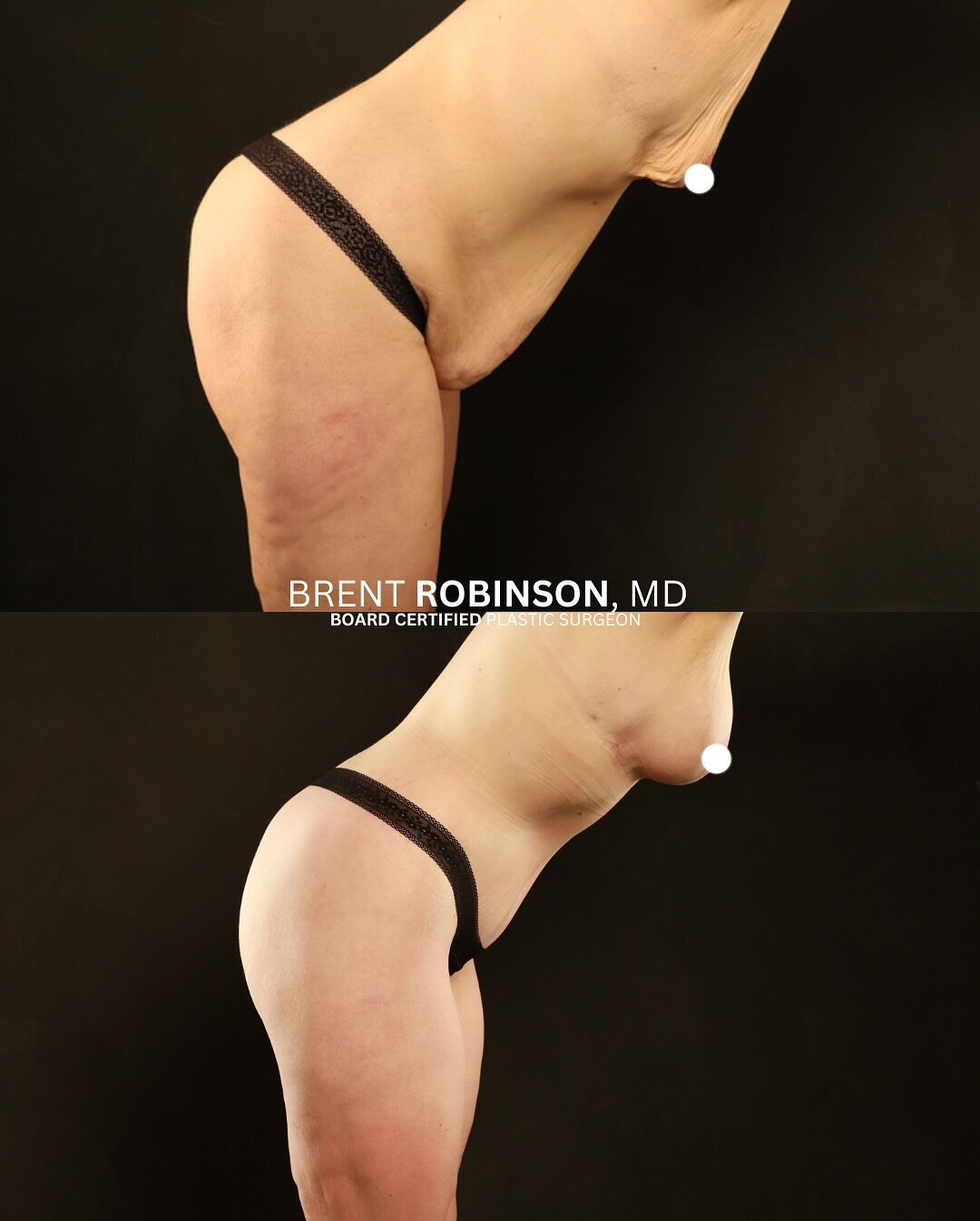 Mommy Makeover Gallery Before & After Image