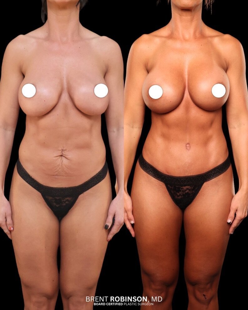 Mommy Makeover Gallery Before & After Image
