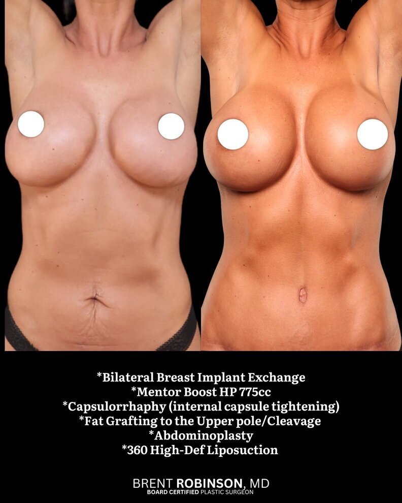 Mommy Makeover Gallery Before & After Image