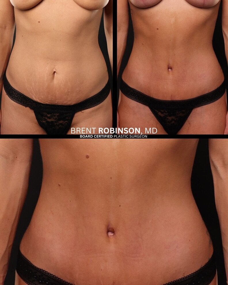 Mommy Makeover Gallery Before & After Image