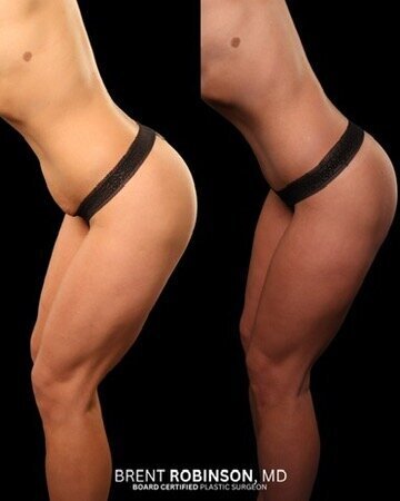 Mommy Makeover Gallery Before & After Image