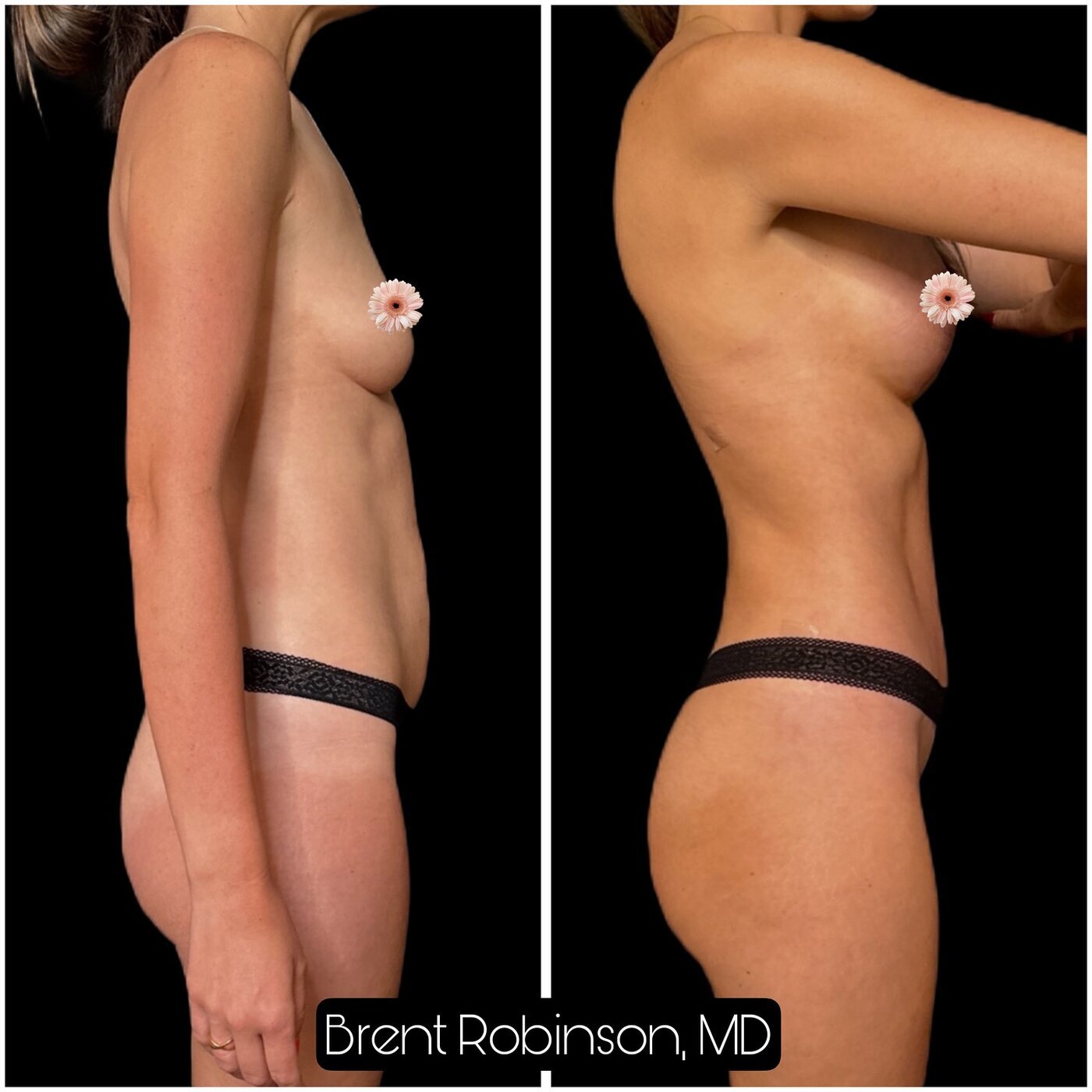 Mommy Makeover Gallery Before & After Image