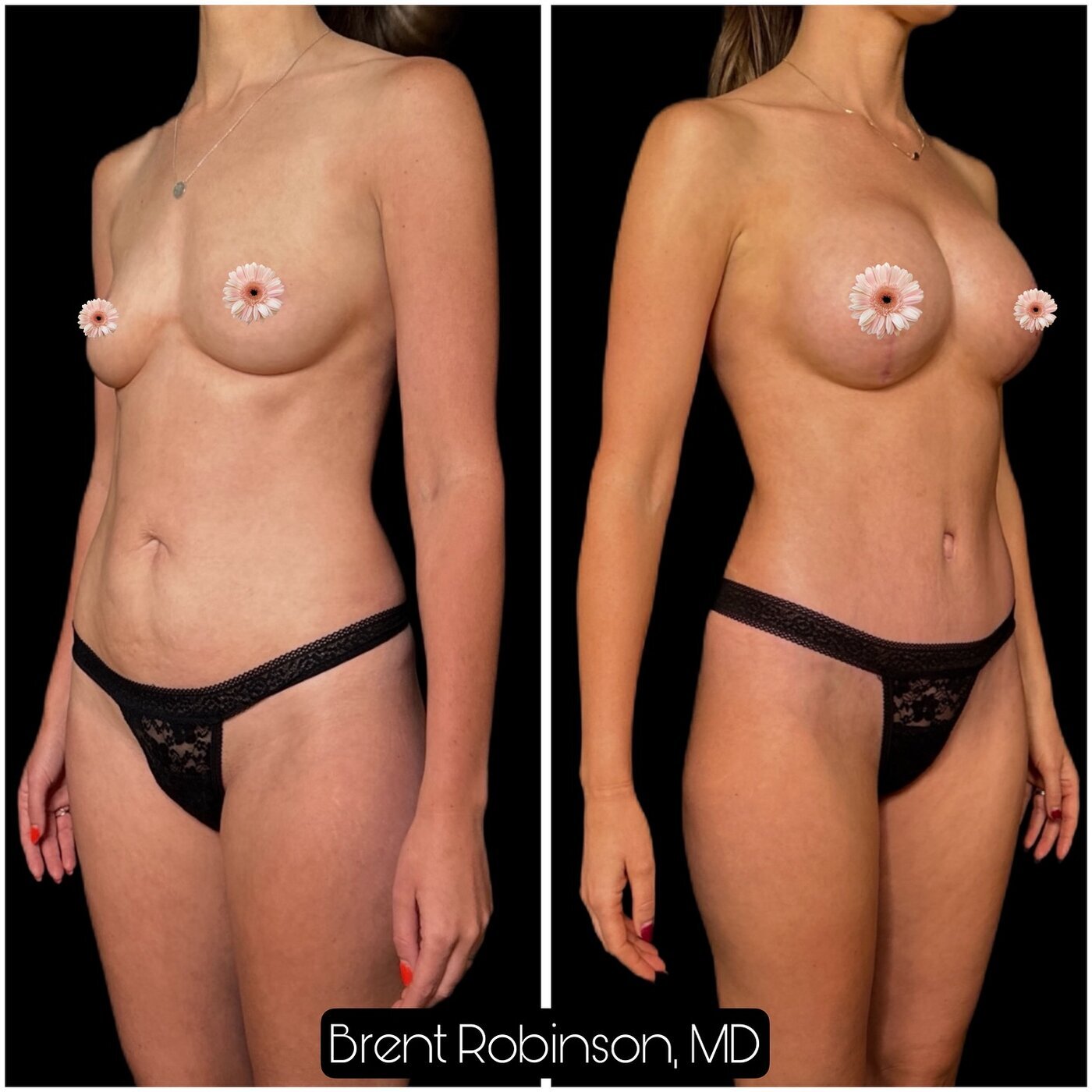 Mommy Makeover Gallery Before & After Image