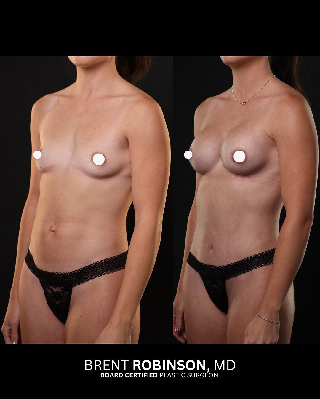 Mommy Makeover Gallery Before & After Image