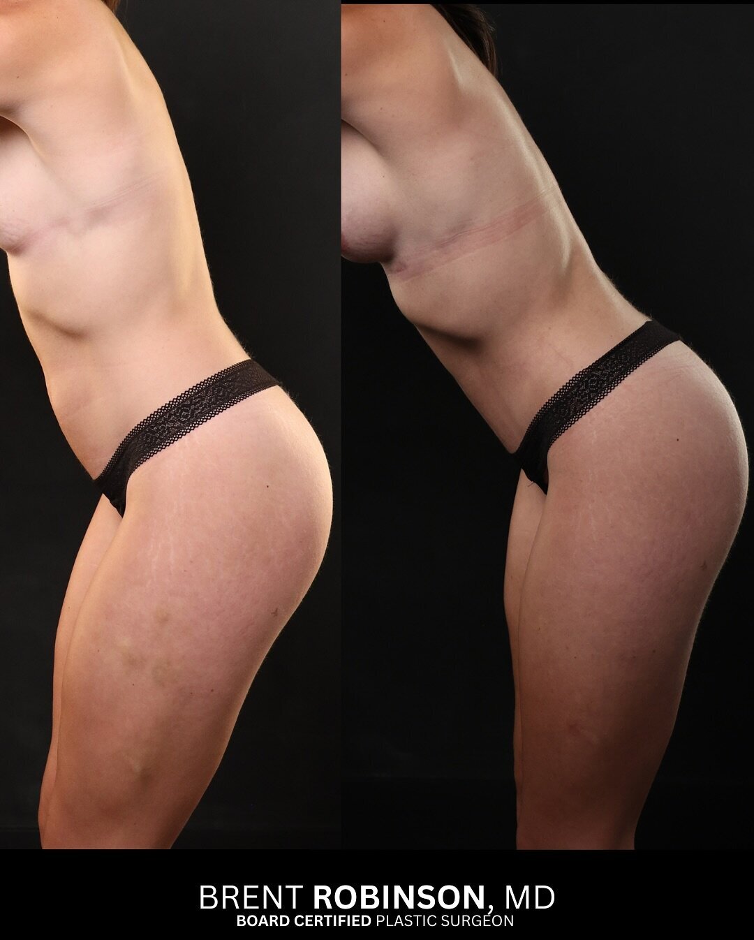 Mommy Makeover Gallery Before & After Image