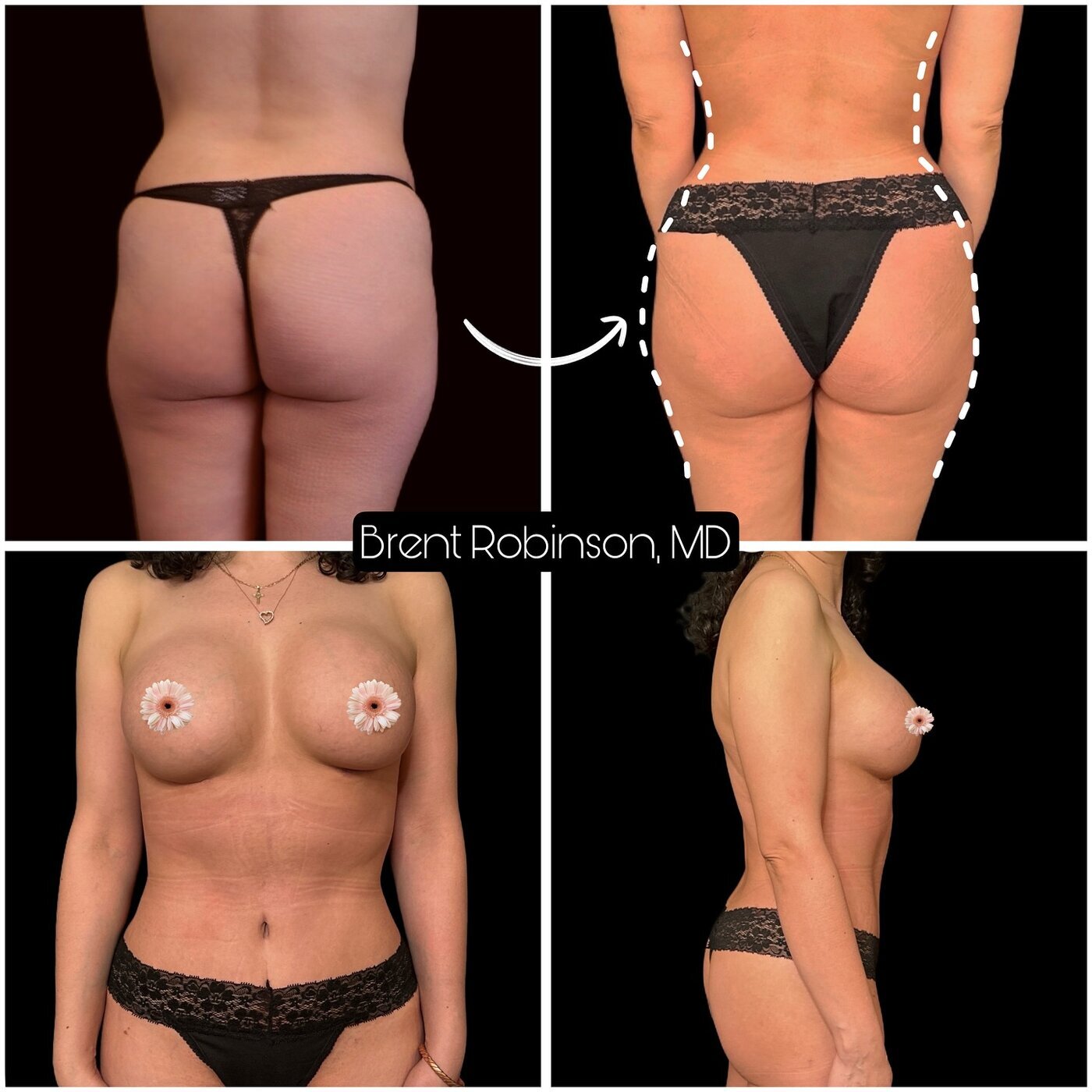 Mommy Makeover Gallery Before & After Image