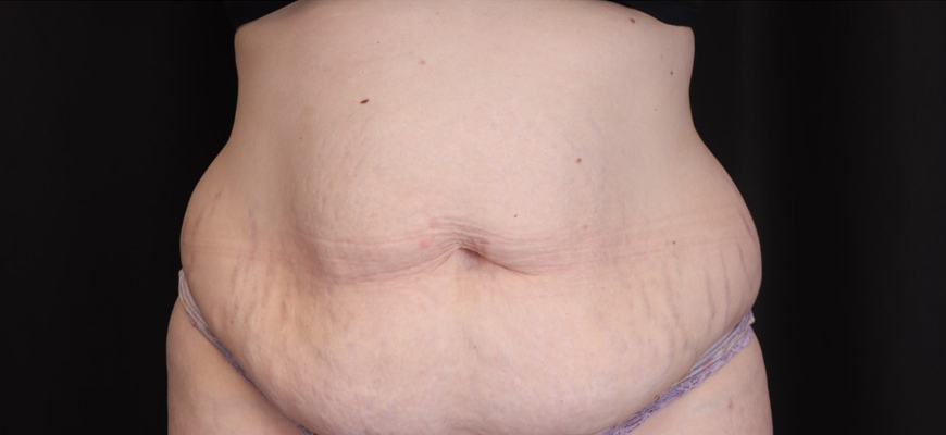 Tummy Tuck Gallery Before & After Image