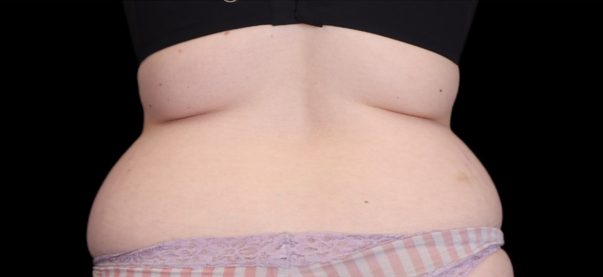 Tummy Tuck Gallery Before & After Image