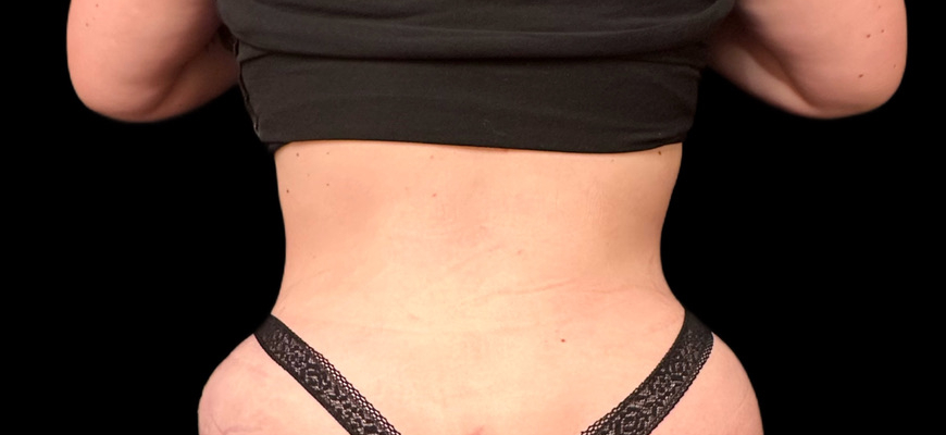 Tummy Tuck Gallery Before & After Image