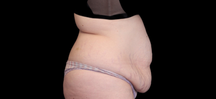 Tummy Tuck Gallery Before & After Image