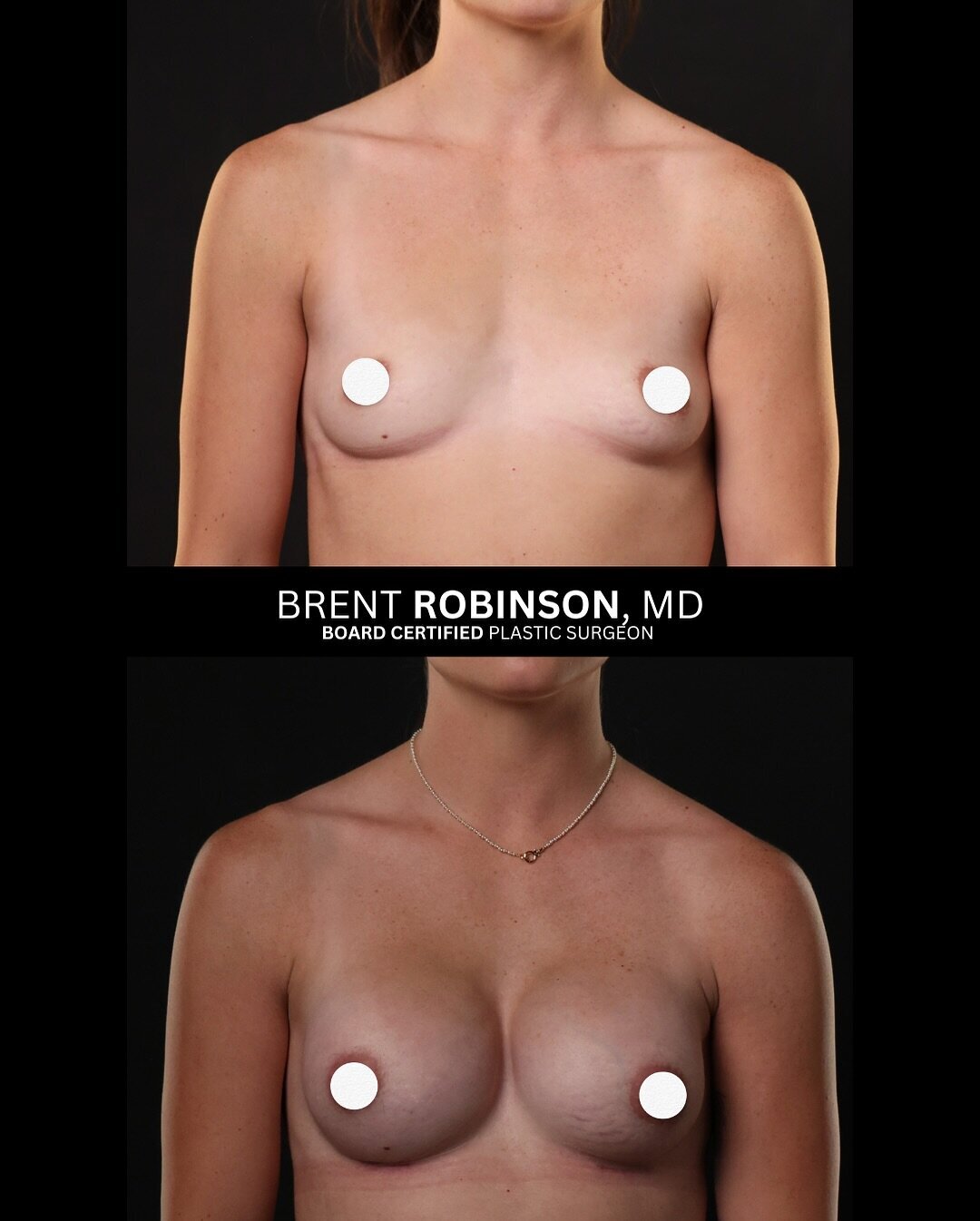 Breast Augmentation Gallery Before & After Image