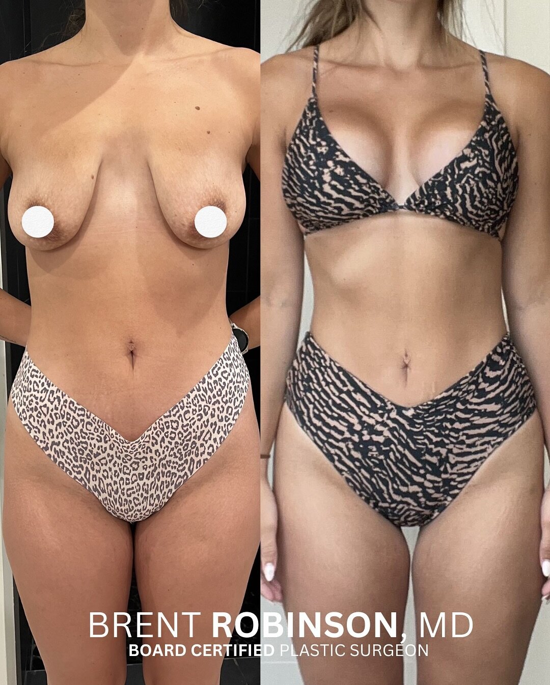 Breast Lift Gallery Before & After Image