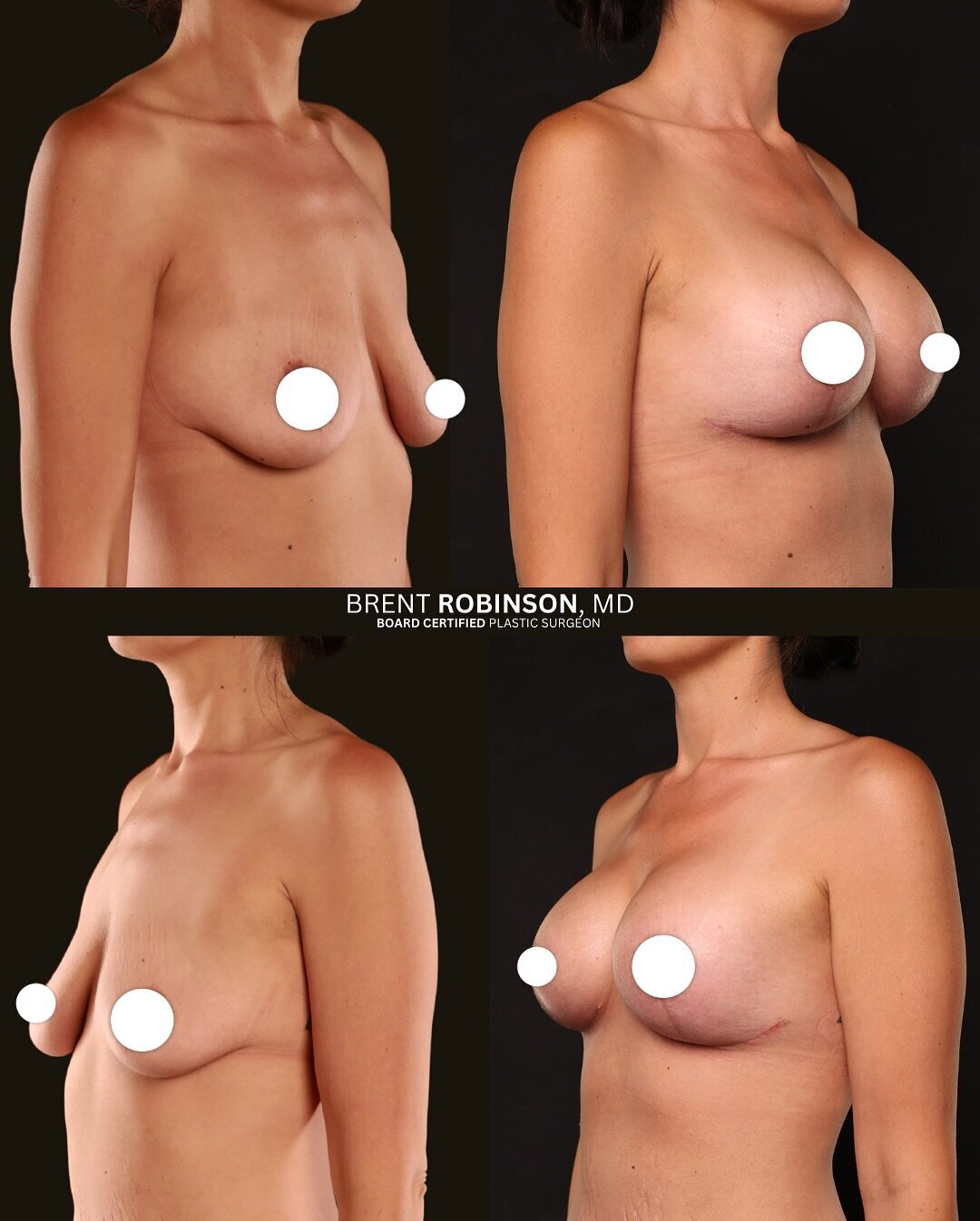 Breast Lift Gallery Before & After Image