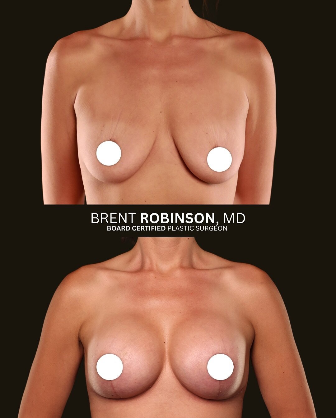 Breast Lift Gallery Before & After Image