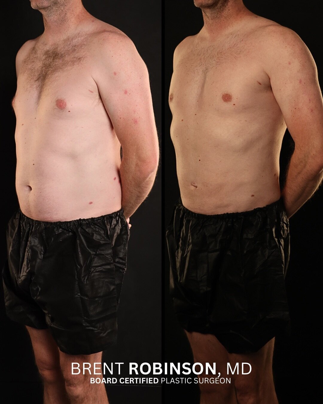 Gynecomastia  Gallery Before & After Image
