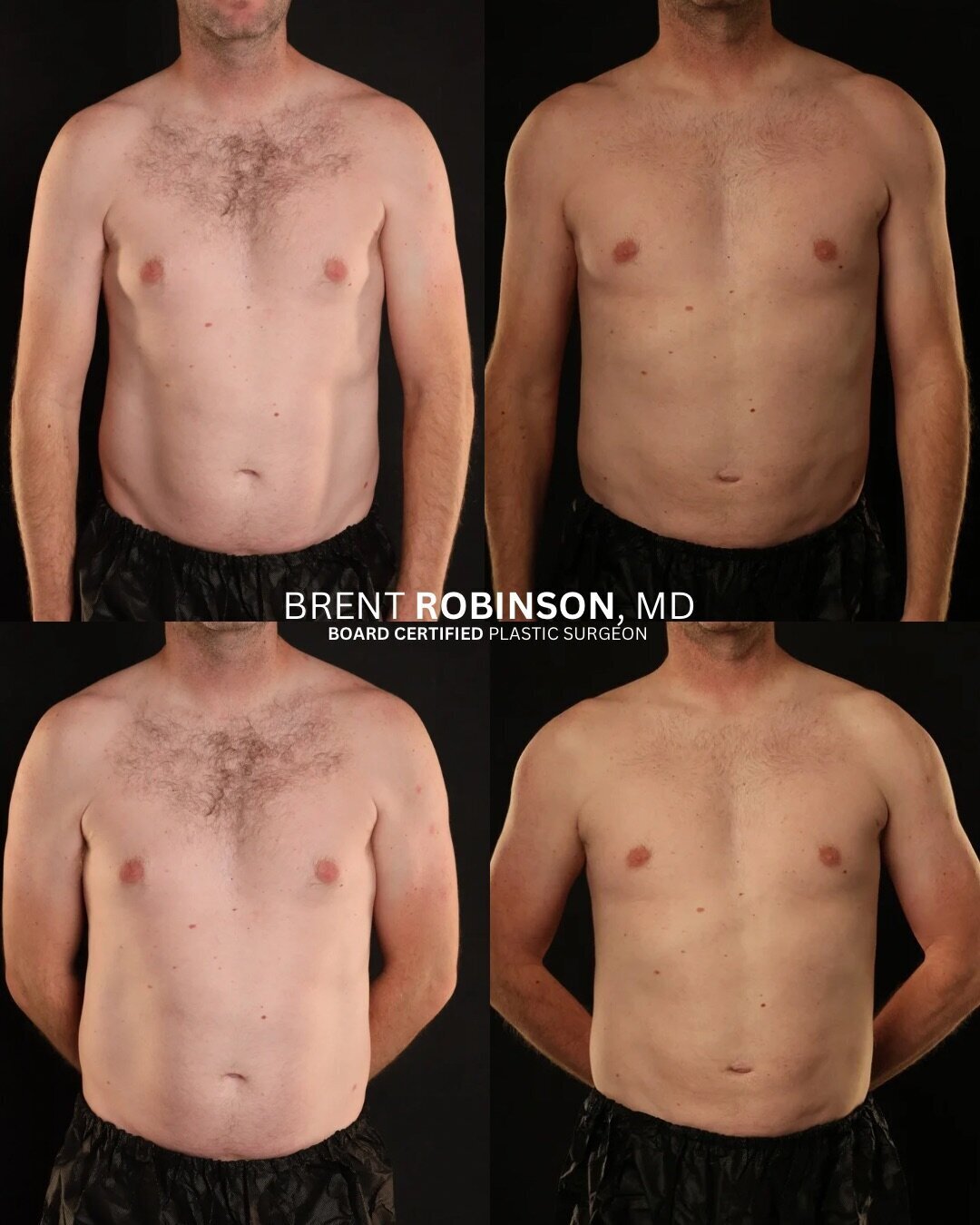 Gynecomastia  Gallery Before & After Image