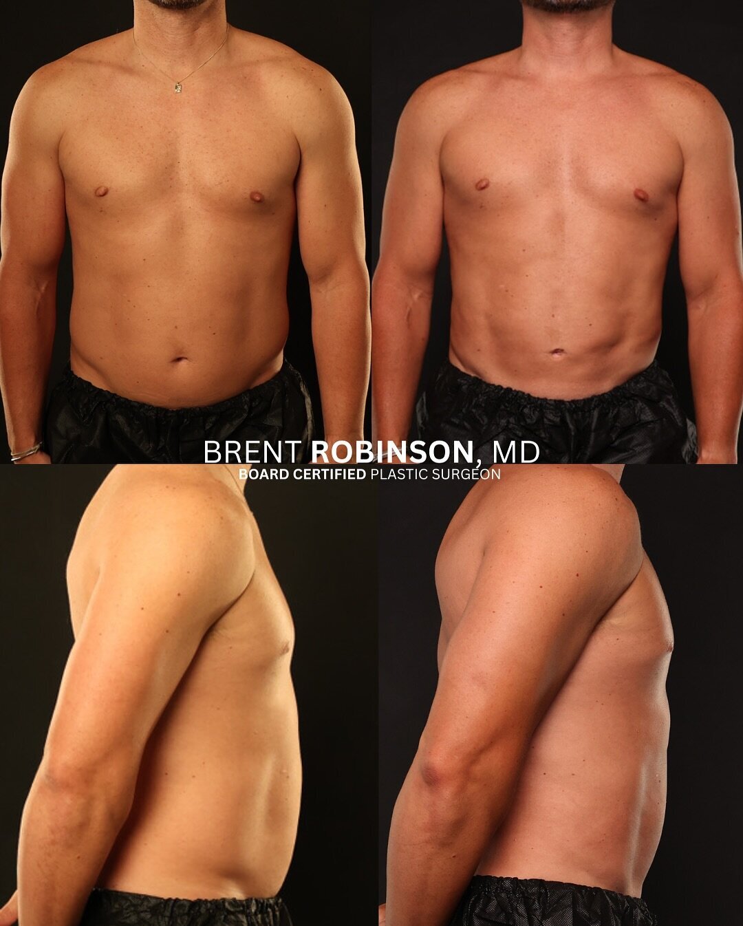 Gynecomastia  Gallery Before & After Image