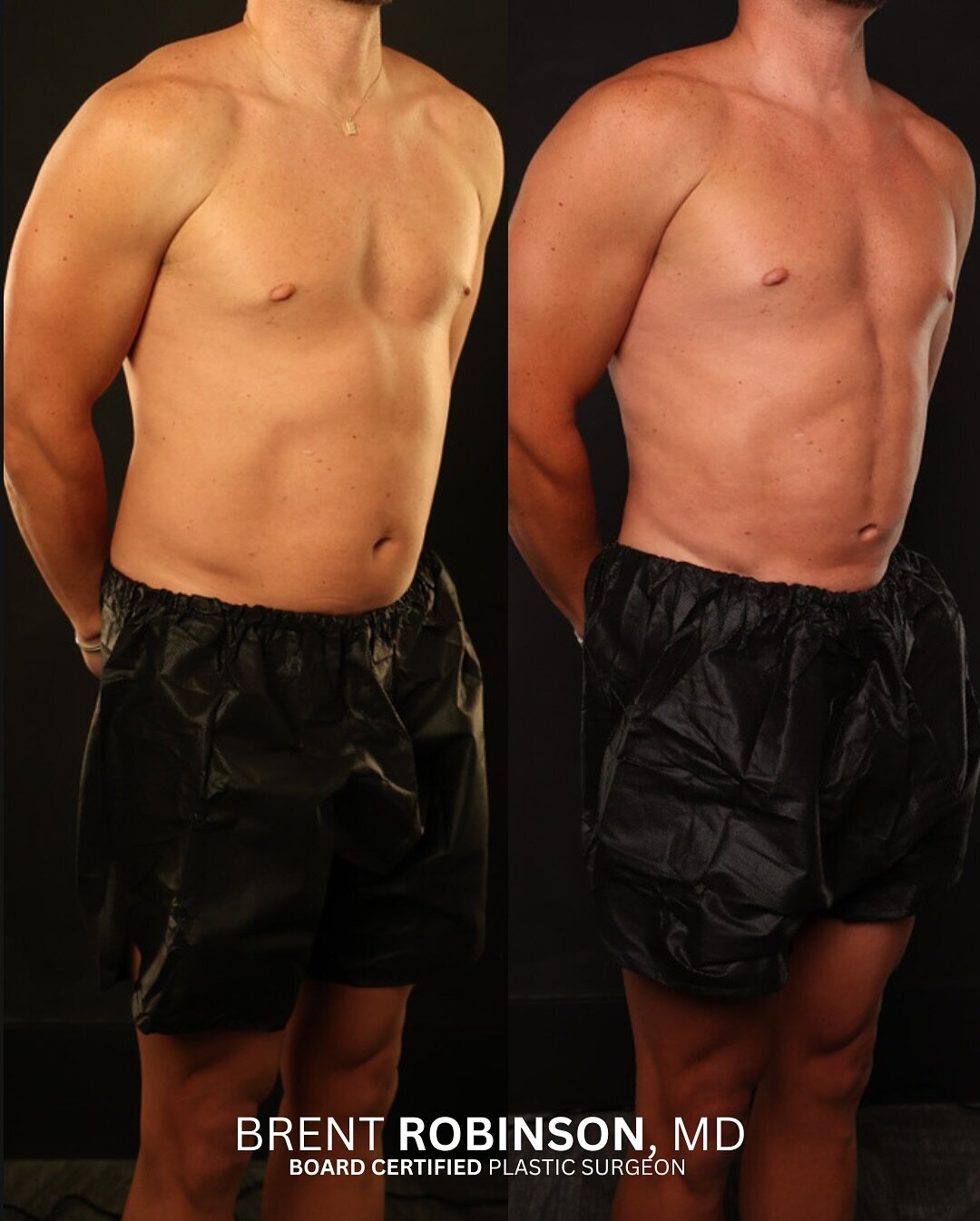 Gynecomastia  Gallery Before & After Image
