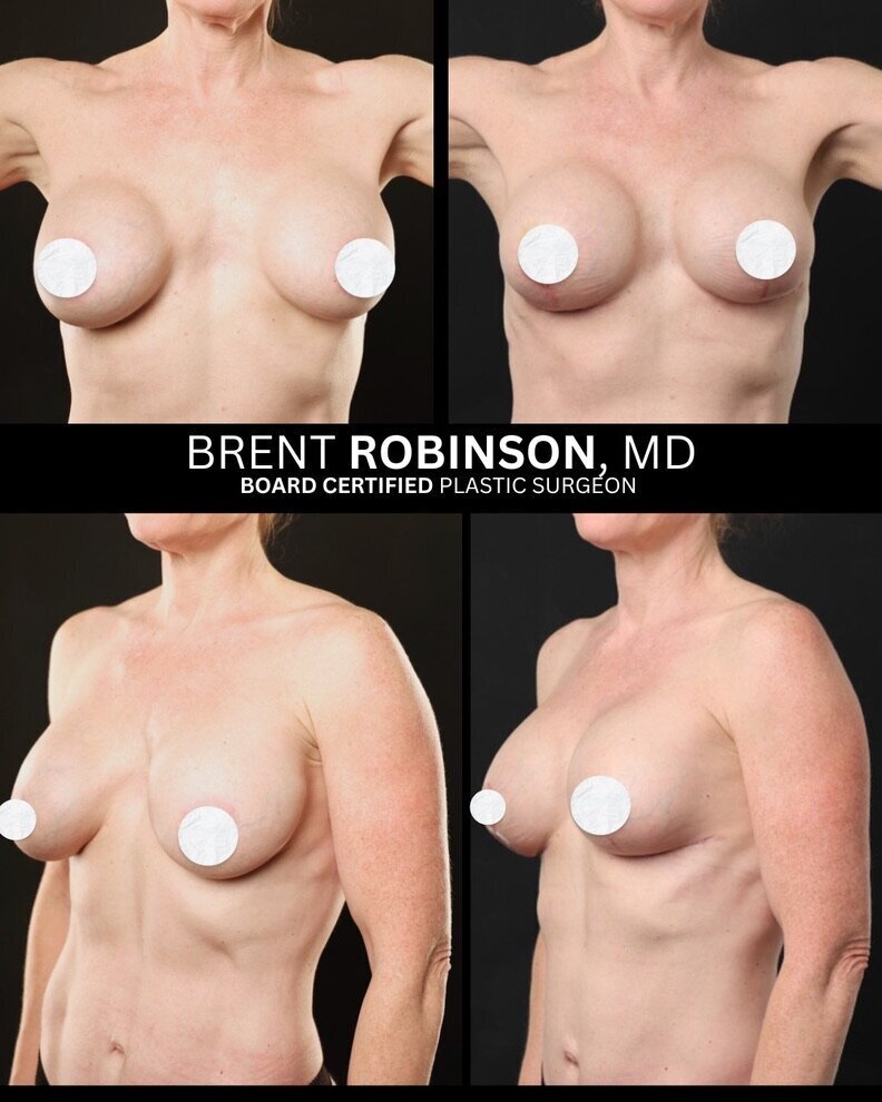 Subfascial Breast Augmentation Gallery Before & After Image