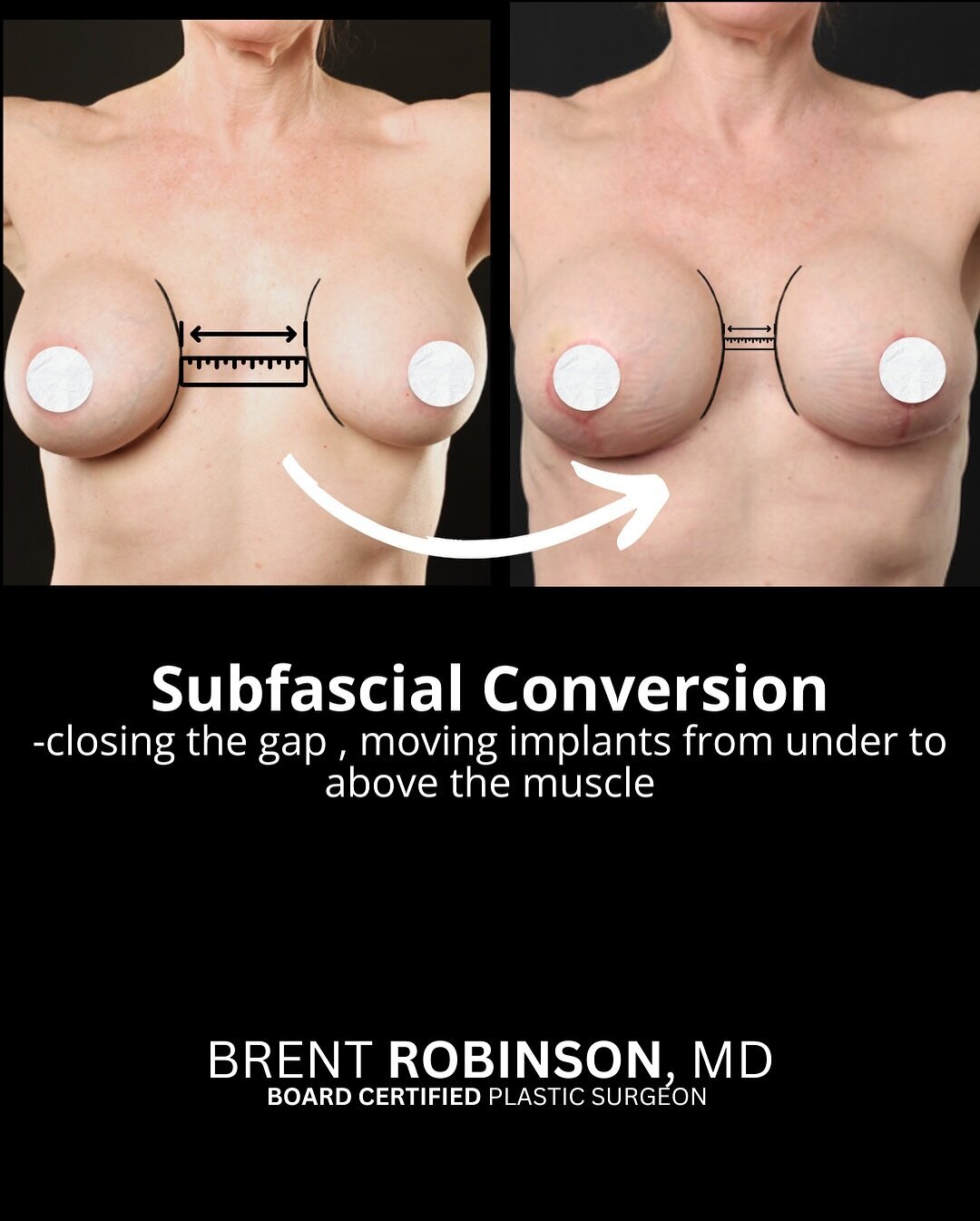 Subfascial Breast Augmentation Gallery Before & After Image