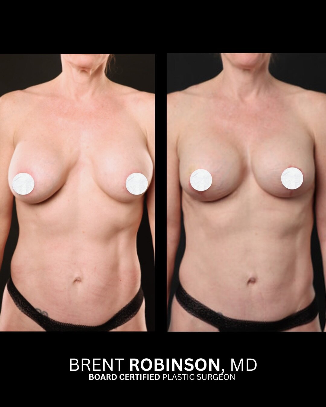 Subfascial Breast Augmentation Gallery Before & After Image