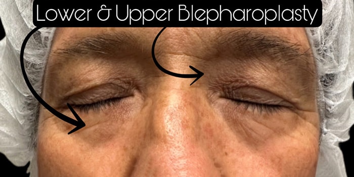 Blepharoplasty Gallery Before & After Image