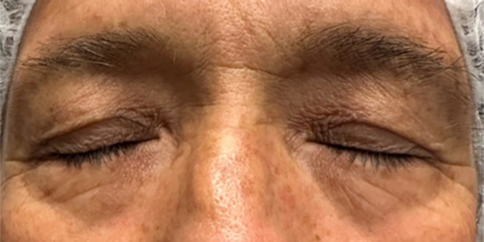 Blepharoplasty Gallery Before & After Image