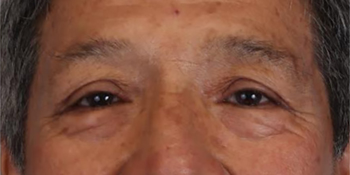 Blepharoplasty Gallery Before & After Image