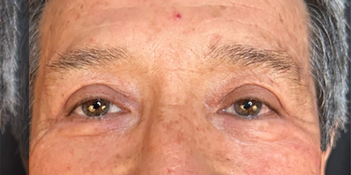 Blepharoplasty Gallery Before & After Image