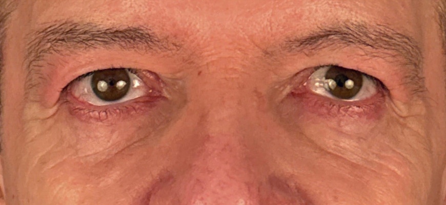Blepharoplasty Gallery Before & After Image