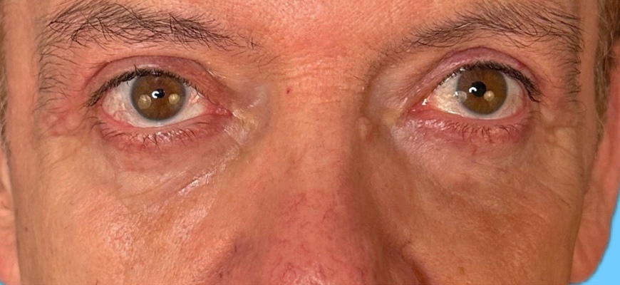 Blepharoplasty Gallery Before & After Image