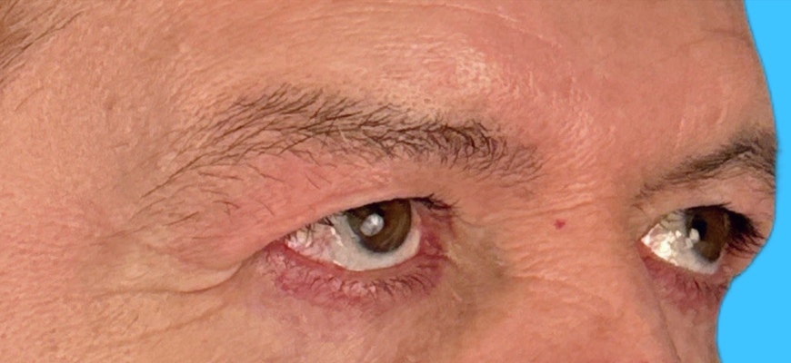 Blepharoplasty Gallery Before & After Image