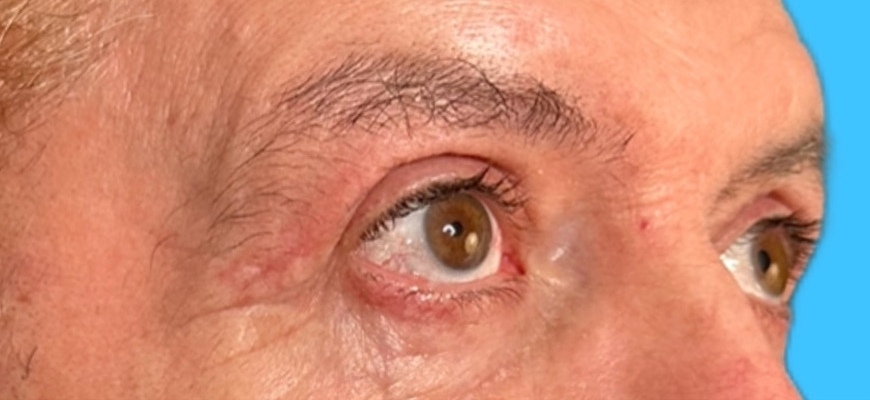 Blepharoplasty Gallery Before & After Image