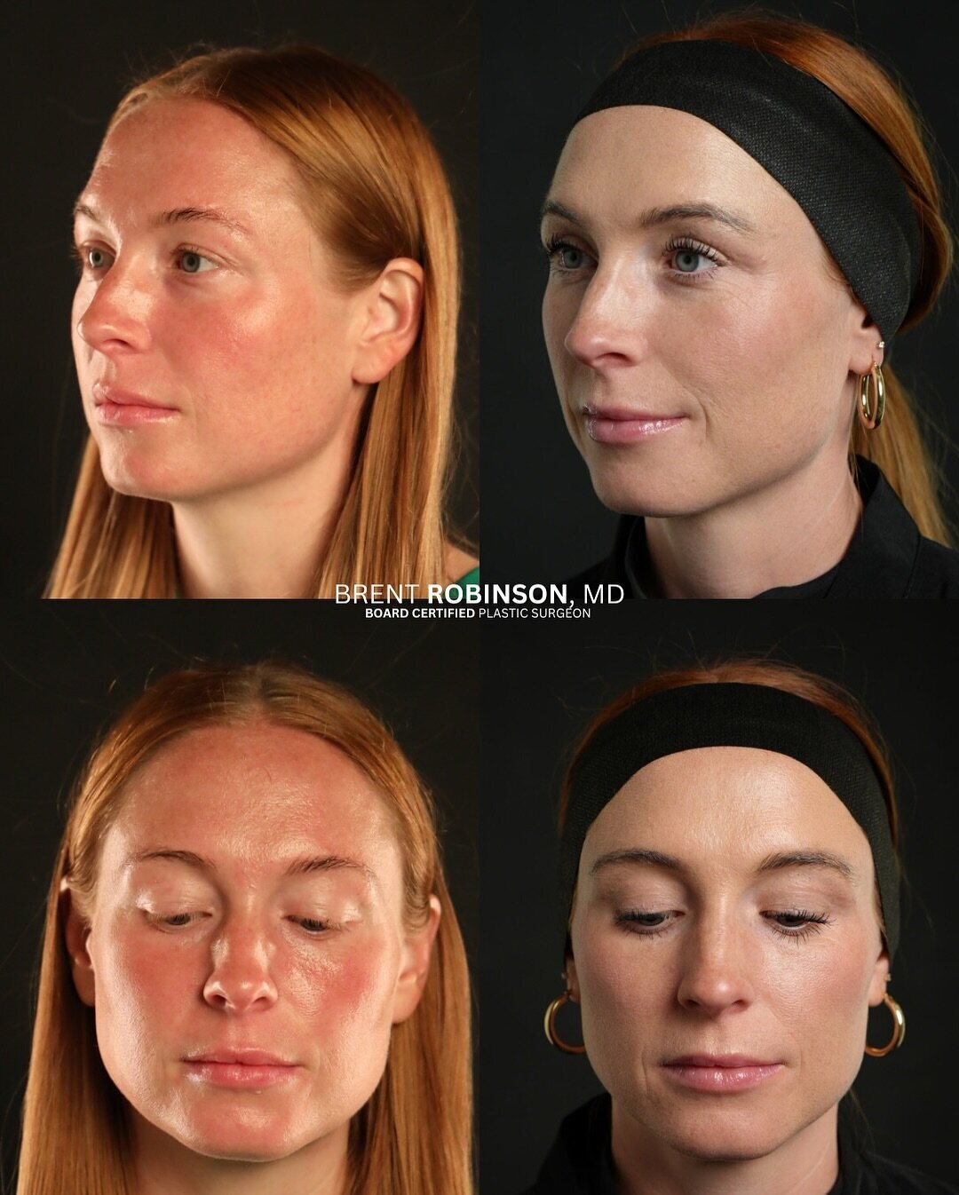 Blepharoplasty Gallery Before & After Image