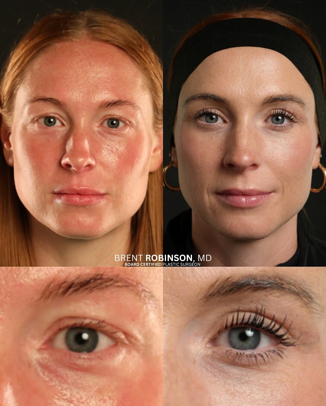 Blepharoplasty Gallery Before & After Image