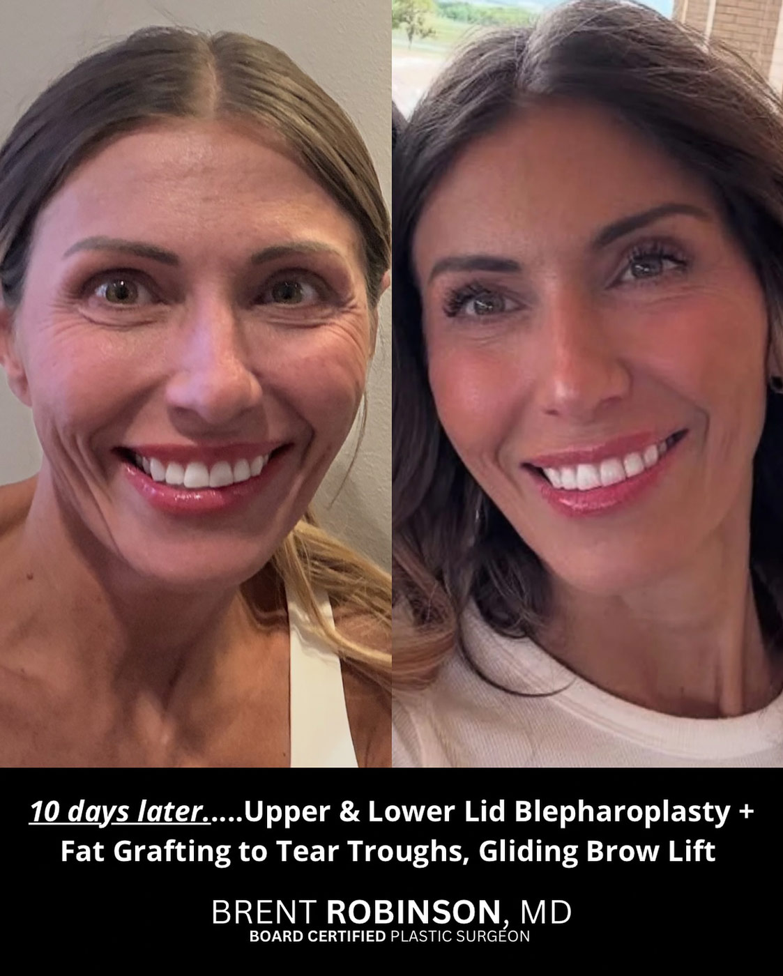 Brow Lift Gallery Before & After Image