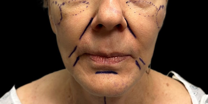 Facelift Gallery Before & After Image