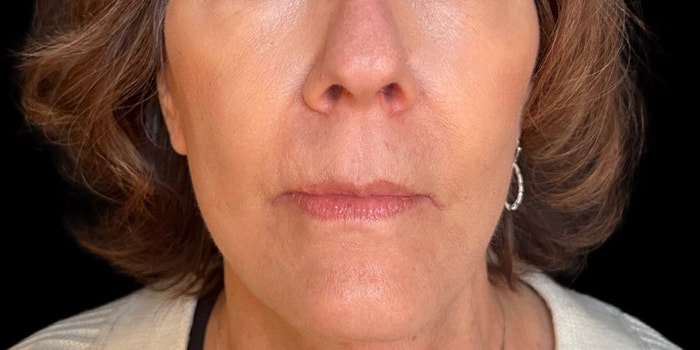 Facelift Gallery Before & After Image