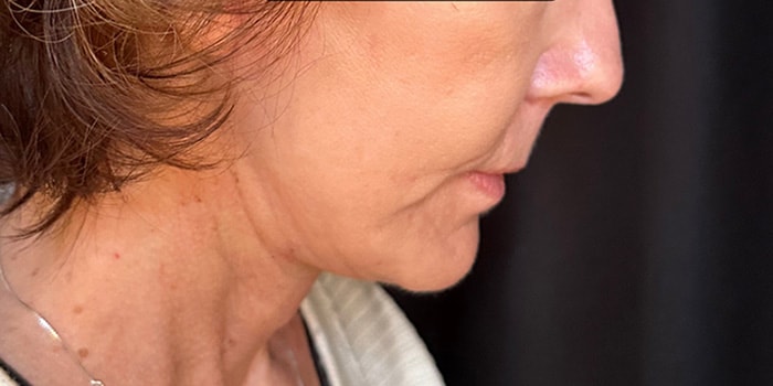 Facelift Gallery Before & After Image